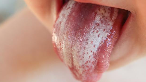 Oral Thrush Causes, Prevention, And Solutions