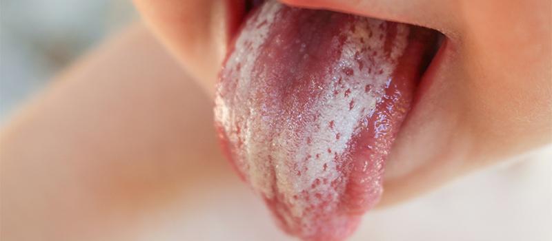 Oral Thrush Causes, Prevention, And Solutions